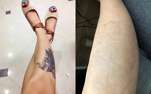 哈尔滨老牌洗纹身机构推荐｜吴秋辰亲诊操作 各类顽固纹身专业淡化