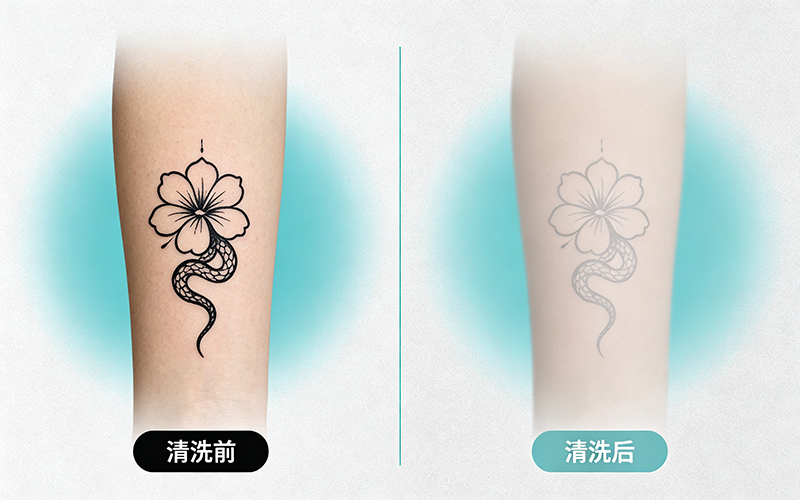 真实案例：黑色线条小面积纹身4次激光清洗前后对比